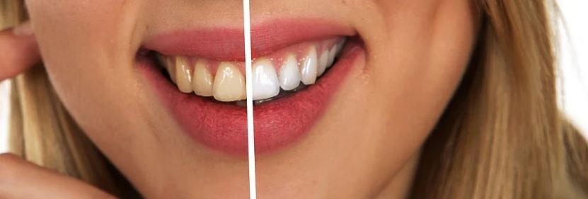 a woman smiling, comparison between yellow and white teeth