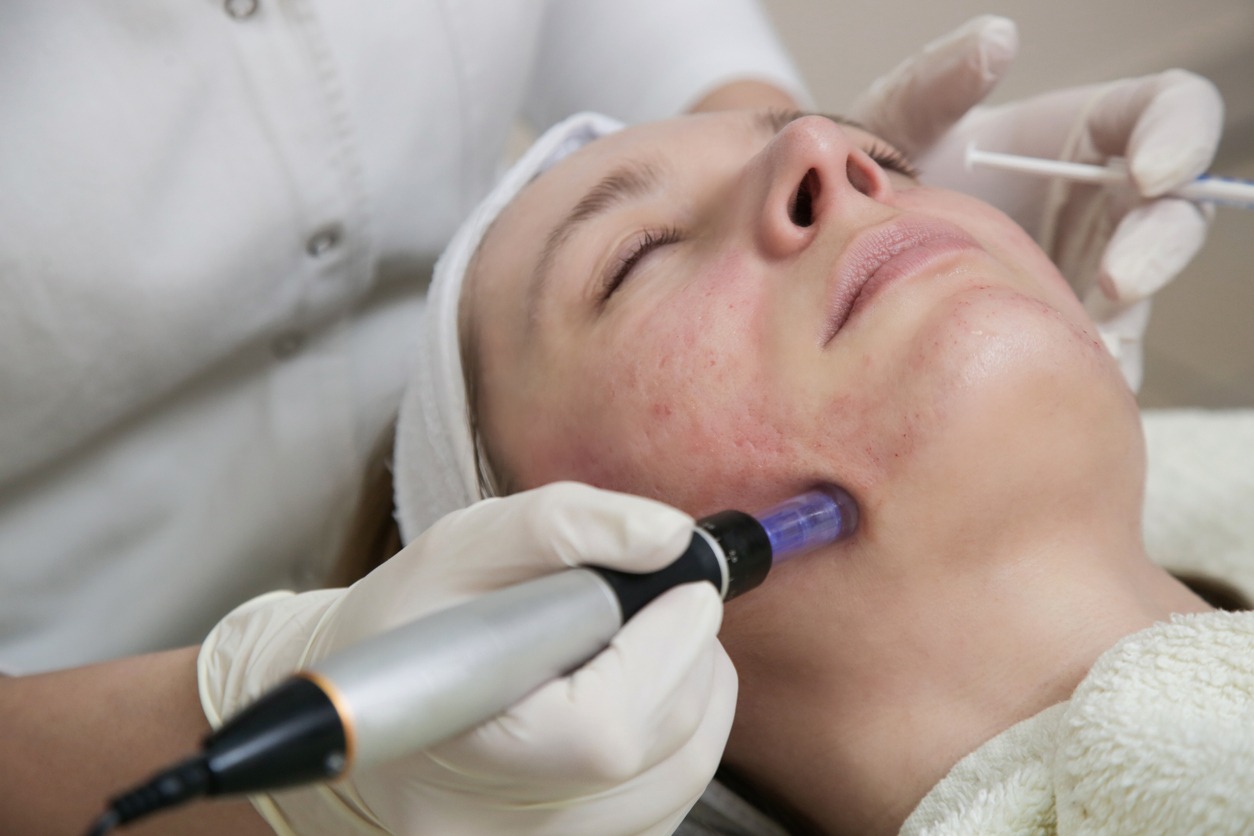 Micro needle cosmetic treatment at dermatologist