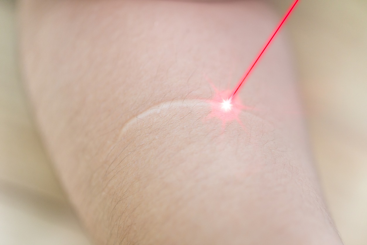 Scar with laser remove technology