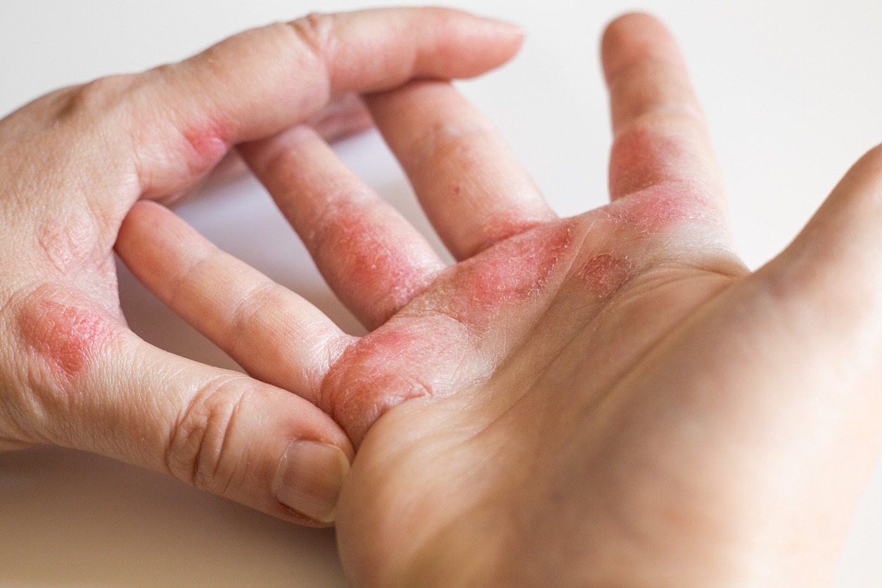 Strong allergic eczema on hands red cracked skin with blisters