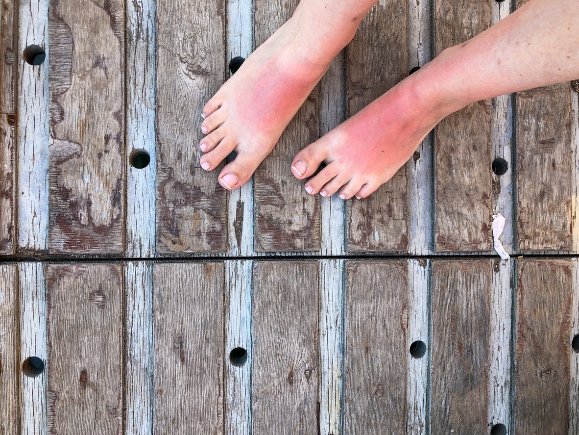 cropped photo of a woman’s sun-burned feet