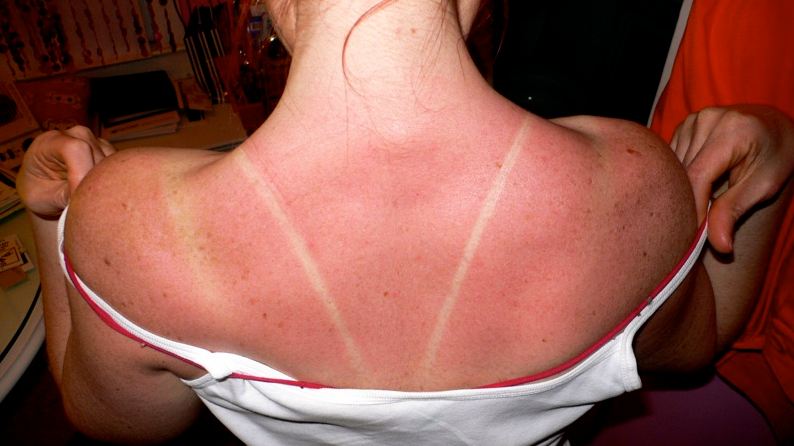 woman-with-a-sunburned-back