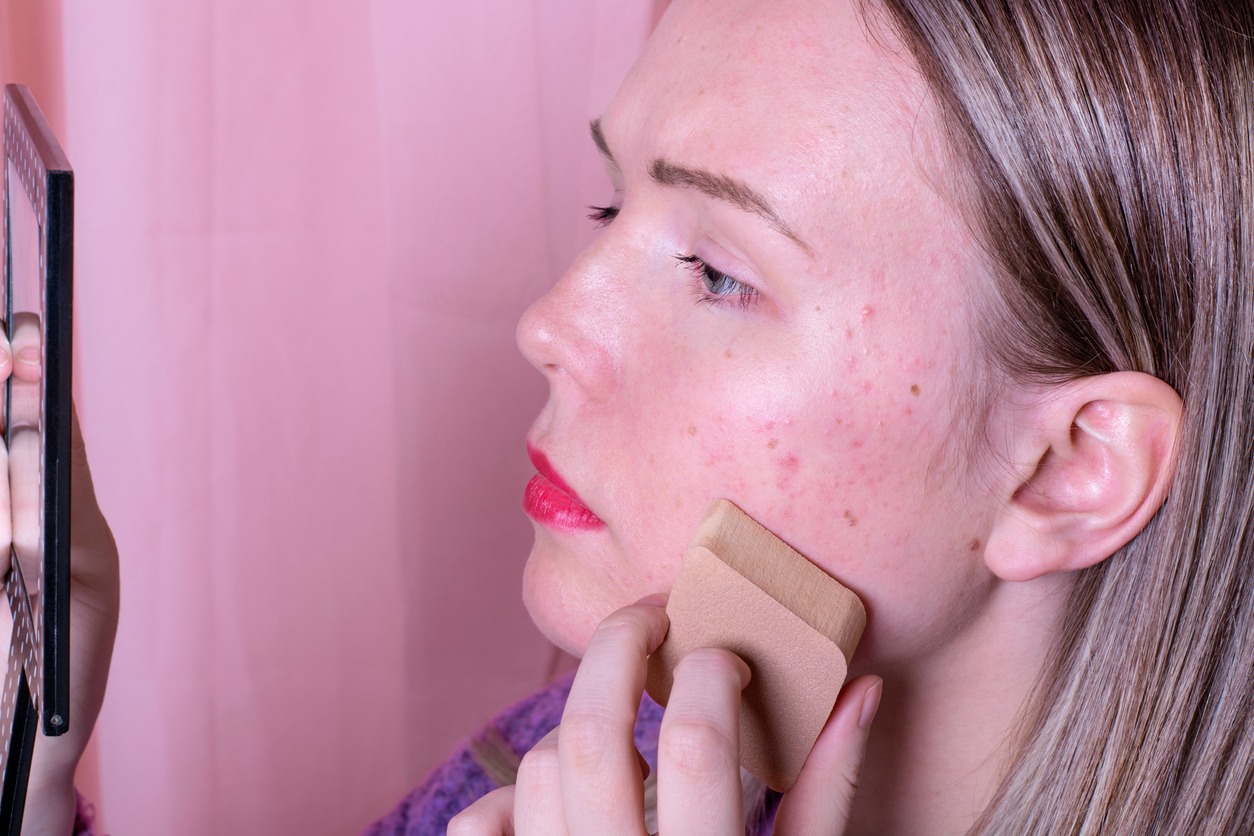 Acne prone skin, Applying moisturizer for acne prone skin
