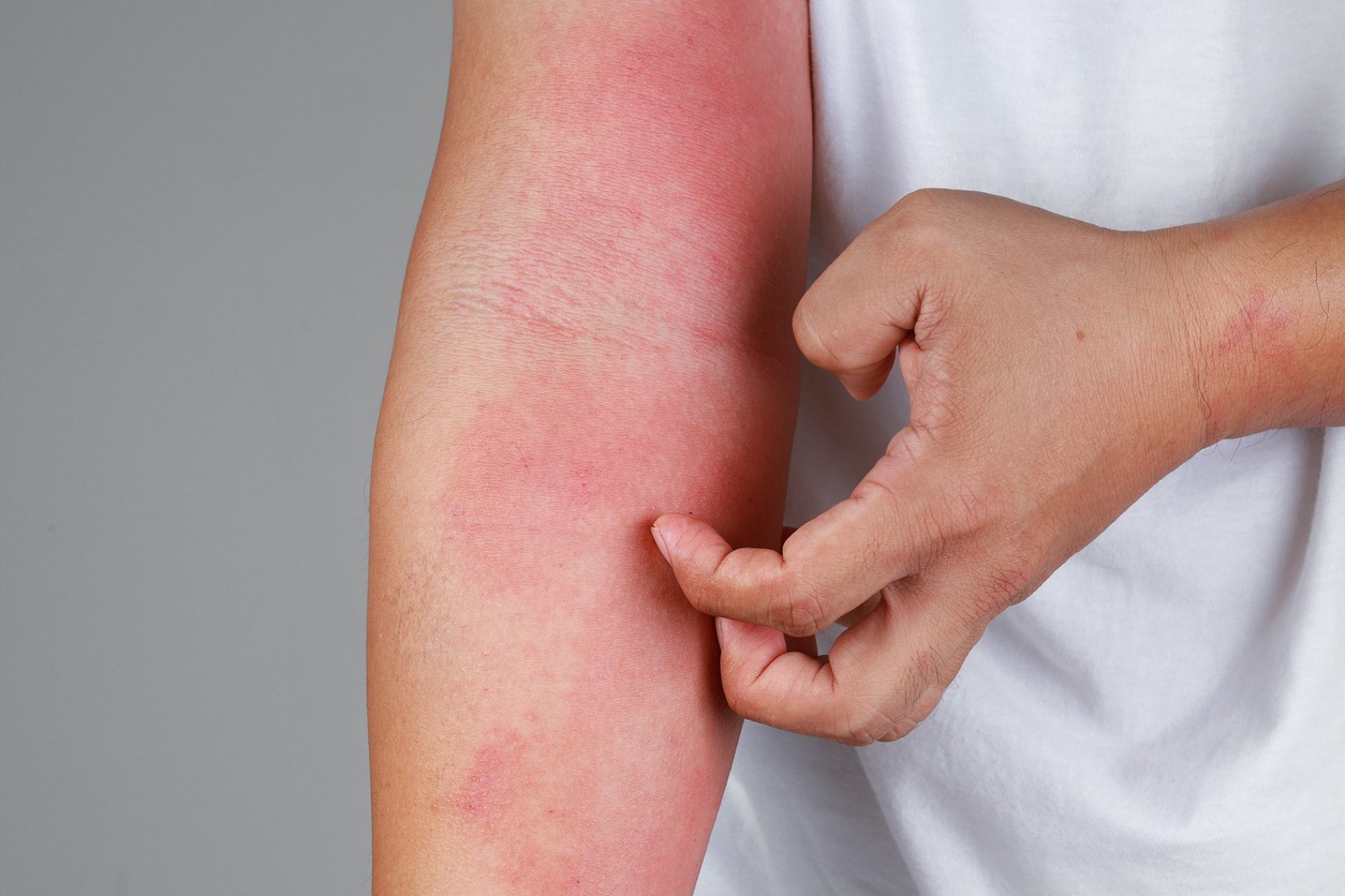Arms with rashes