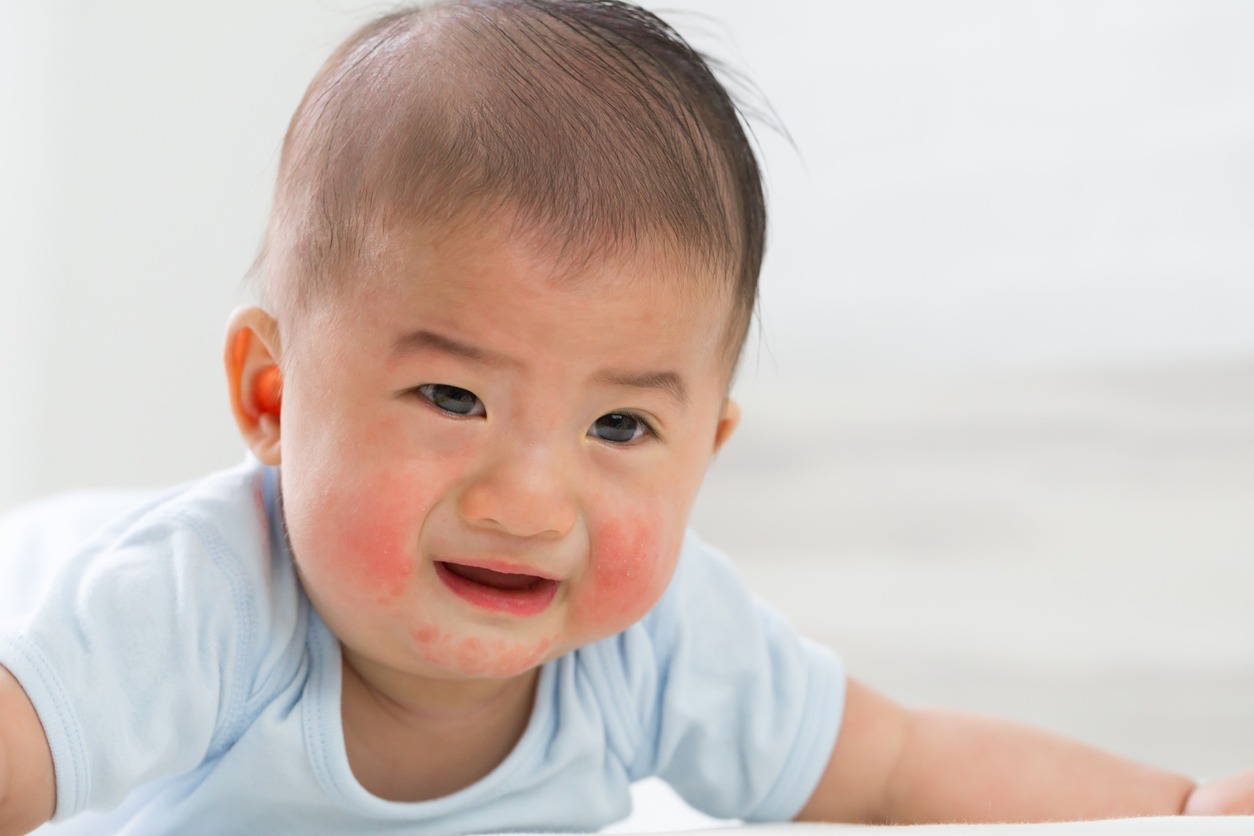 Baby with signs of eczema