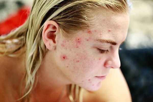 Soaps-to-Help-Calm-Acne-Breakouts