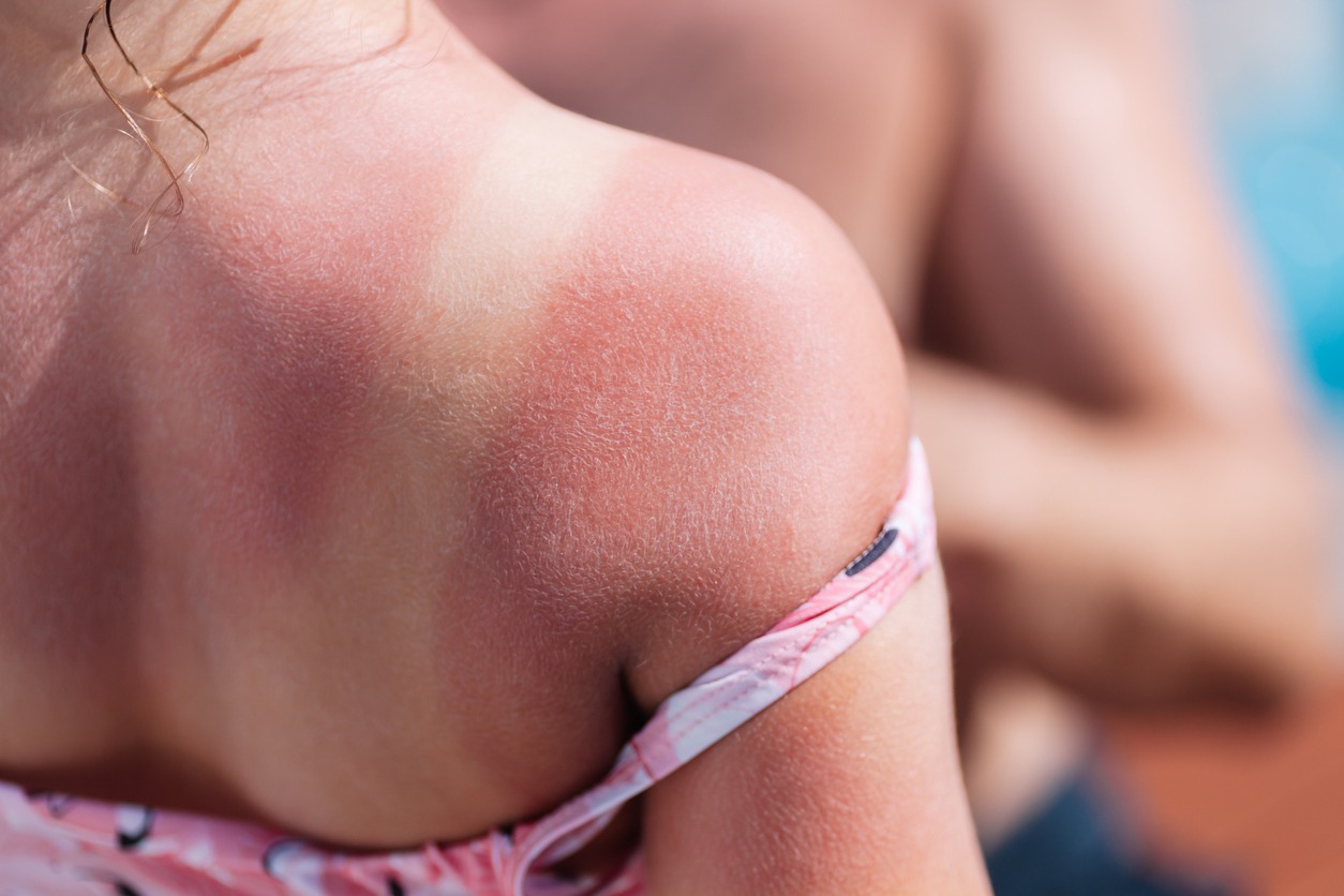 Sunburn Skin, Red back of a girl, Sunburn and white lines