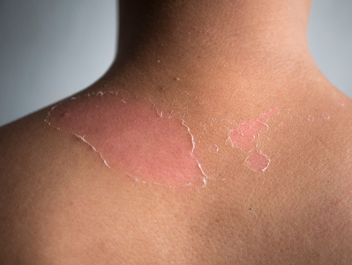 Sunburned Skin, Peeling Skin from Sunburn