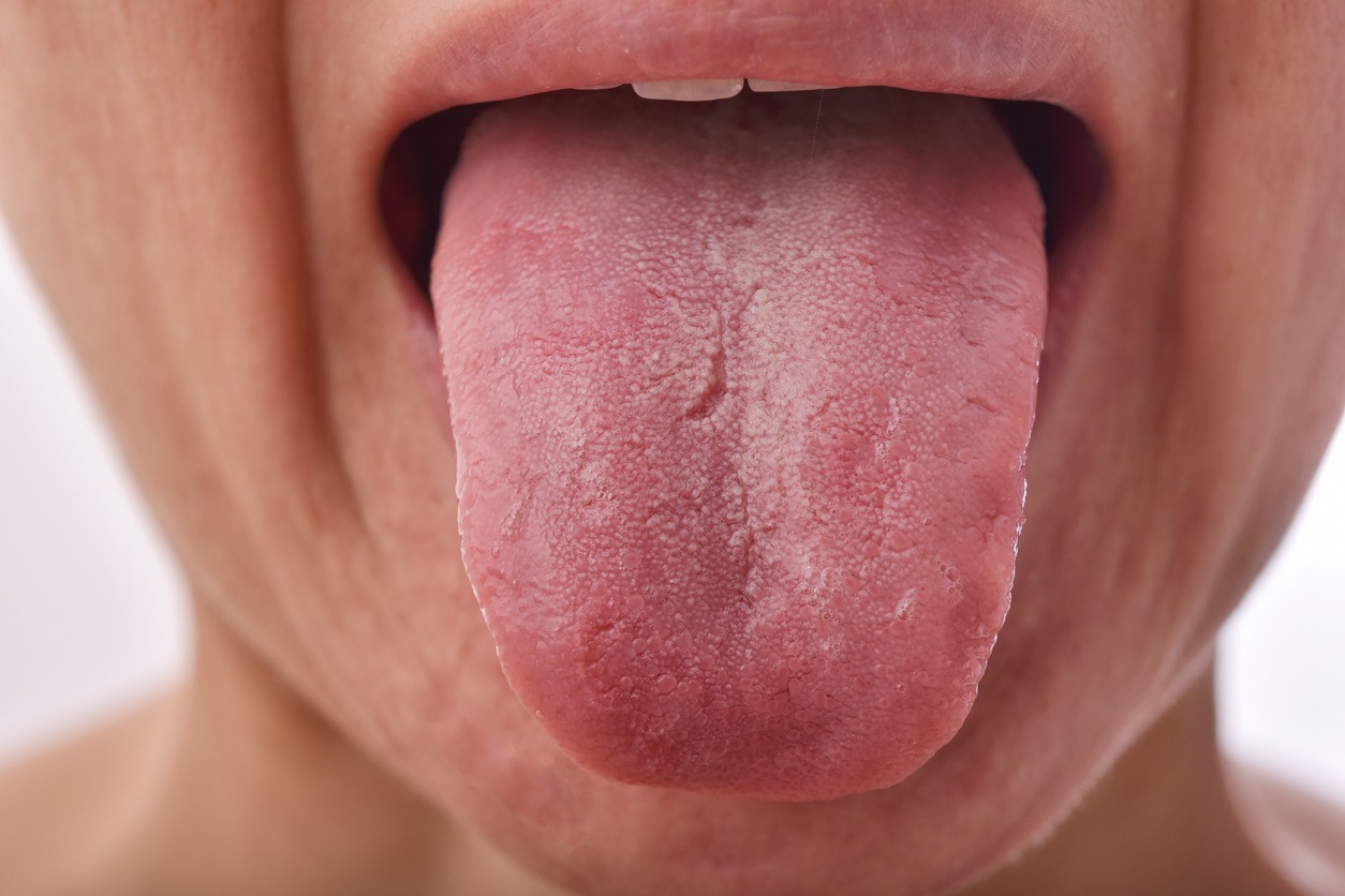 Tongue, Dry Tongue, Tongue Problem