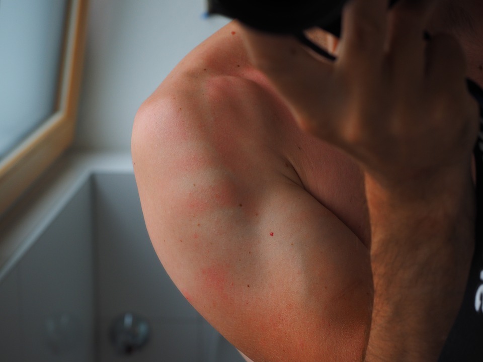 Why-Moisturizing-Sunburnt-Skin-is-Important