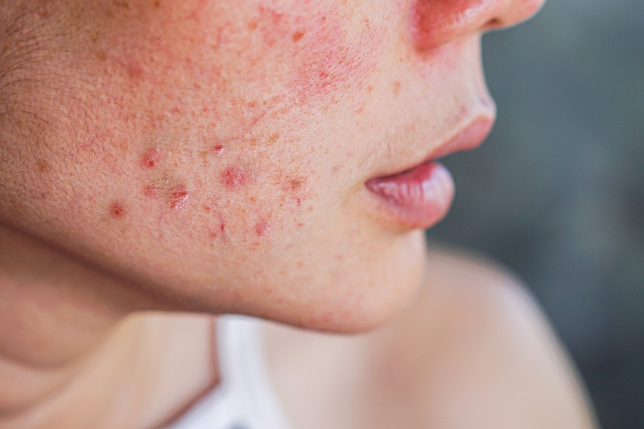 closeup acne on woman's face with rash skin ,scar and spot that allergic to cosmetics