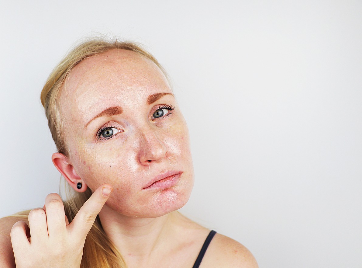 Portrait of a blonde girl with acne, oily skin and pigmentation. Oily and problem skin