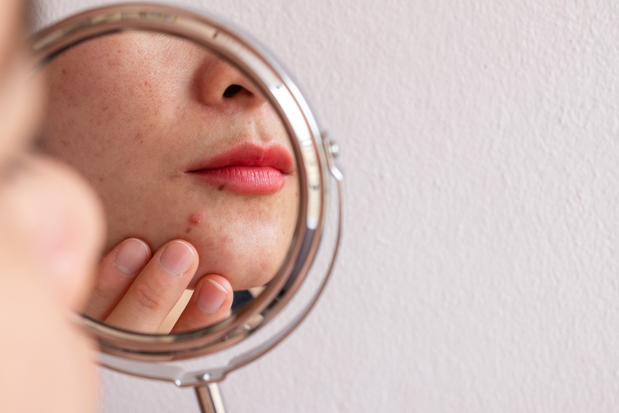 acne, skin problem)

