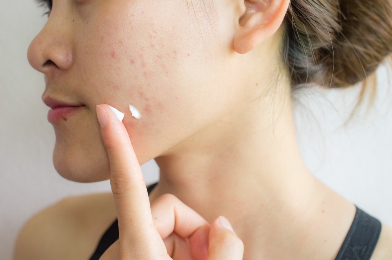 Shot of woman preparing for applying acne cream for solve her problem skin.