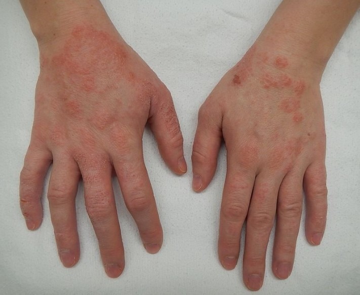 Tips for Treating Eczema