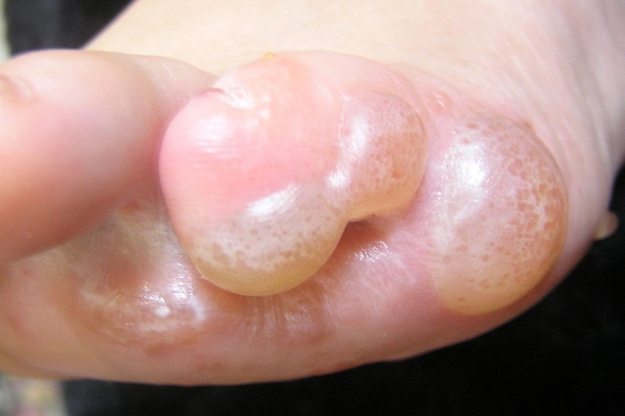 complex-eczema-on-foot
