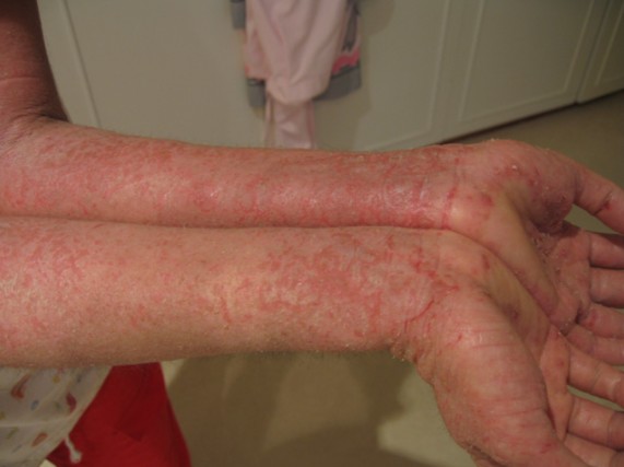 severe-eczema-on-arms-and-hands