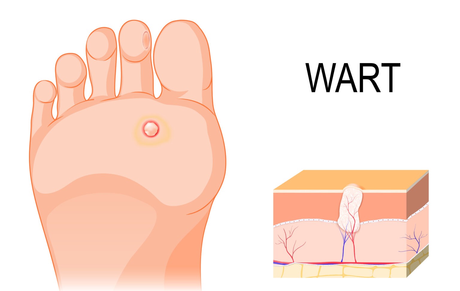 wart-at-the-bottom-of-the-foot
