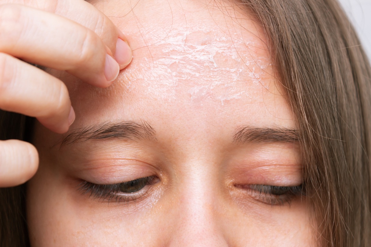 A female forehead with peeling skin