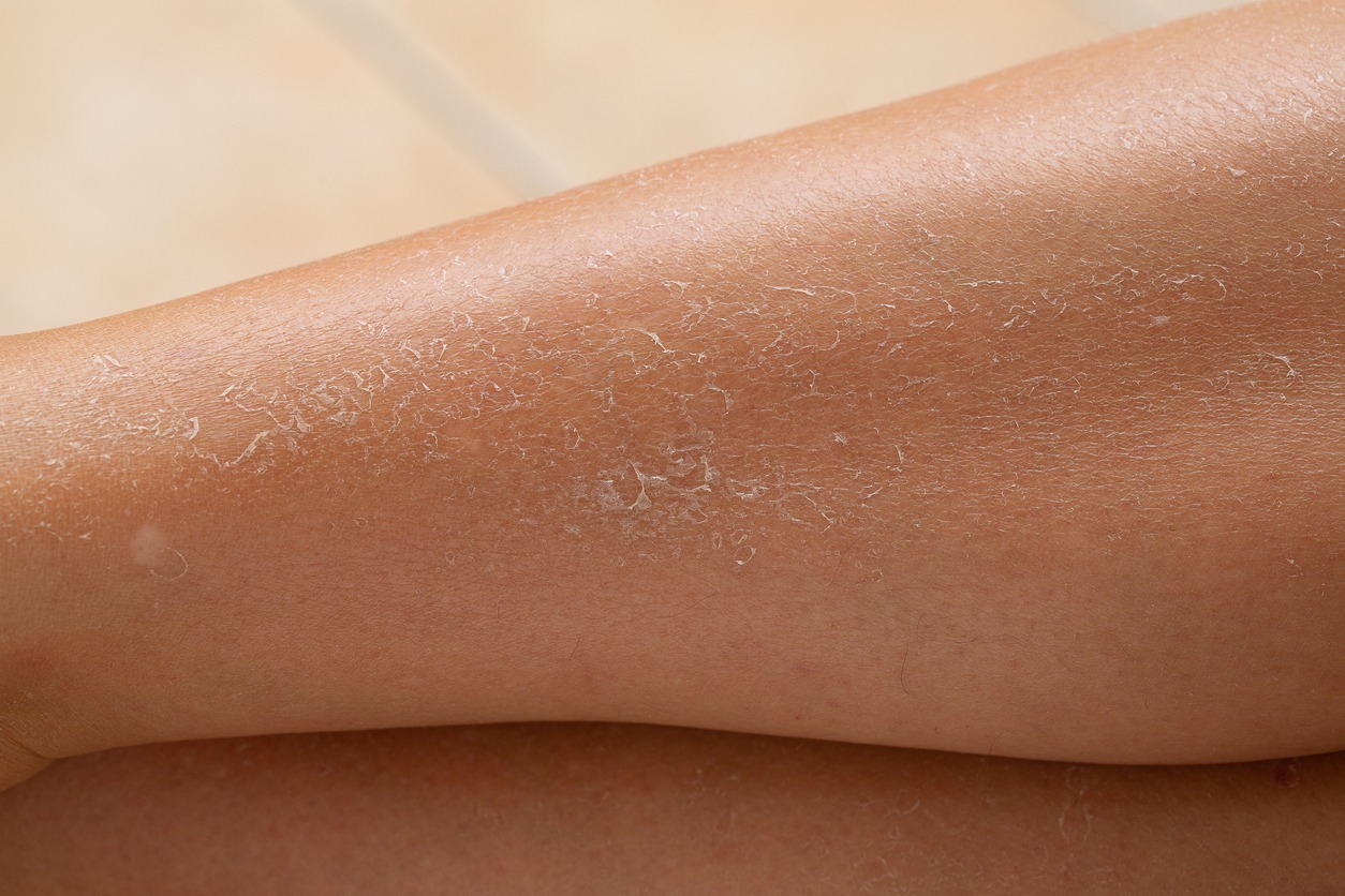 Close-up of female legs with peeling dry skin