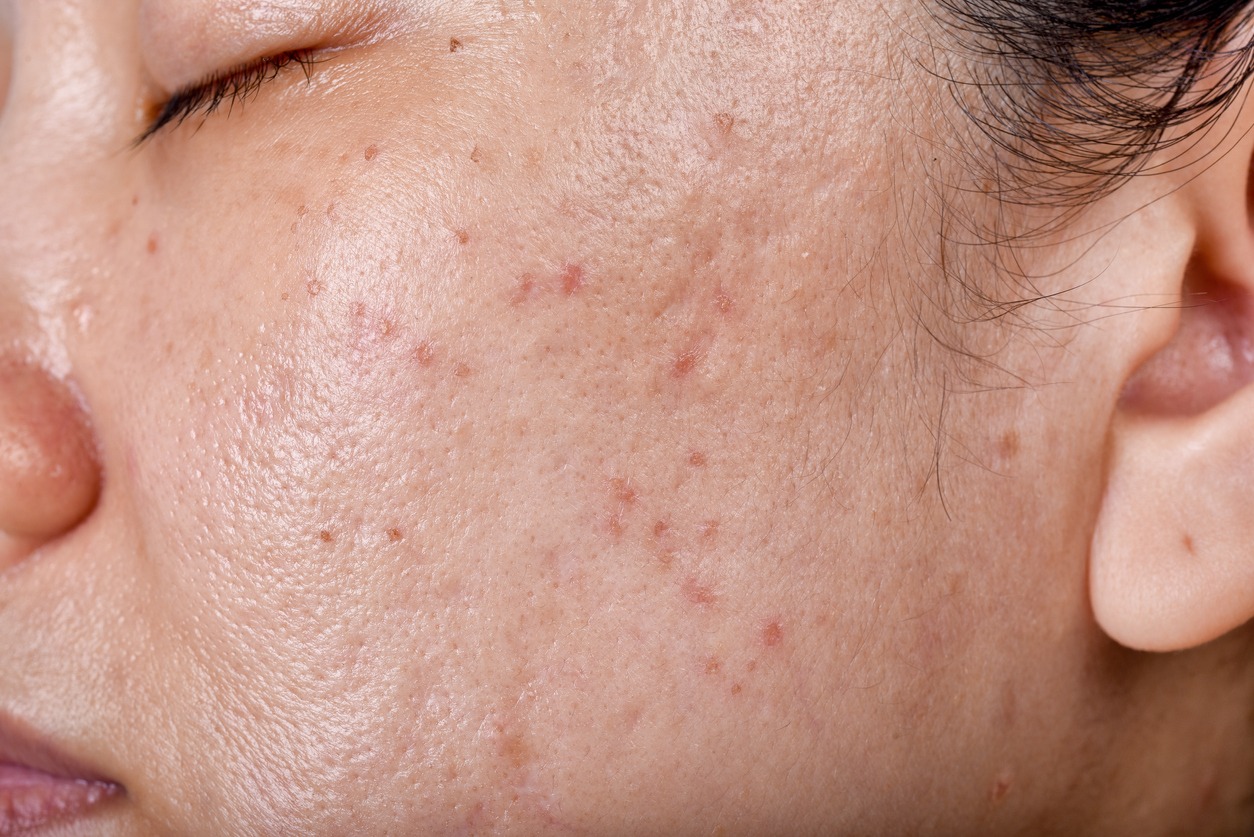 Facial skin problem acne disease in adult close up woman face with whitehead and pimples