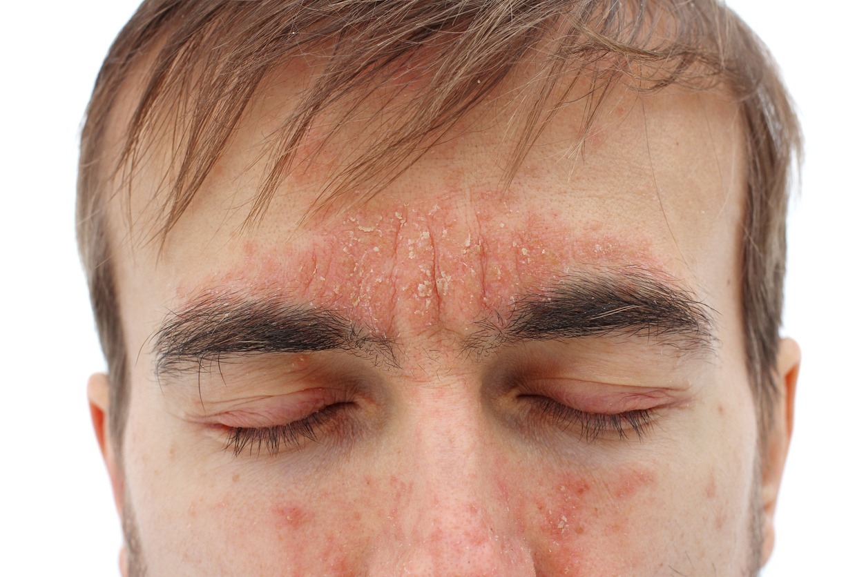 Head of sick man with closed eyes with a red allergic reaction on skin, redness