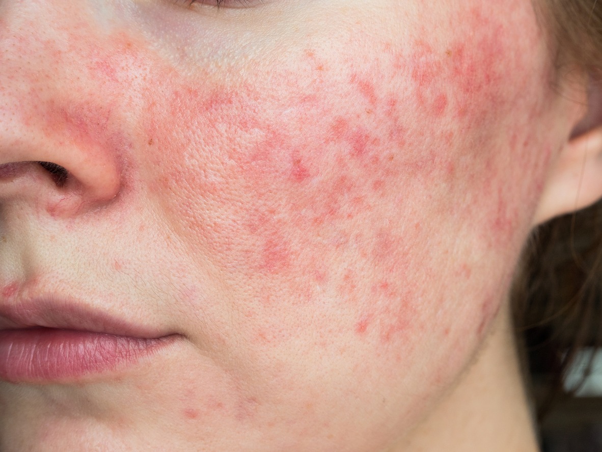 Papulopustular rosacea close-up of the patient's cheek