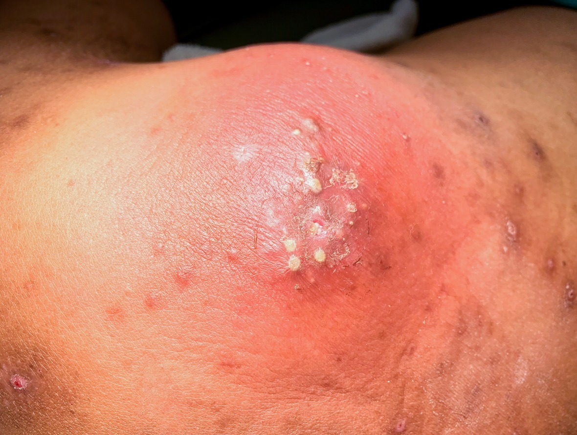 large-skin-abscess-with-pus-discharge